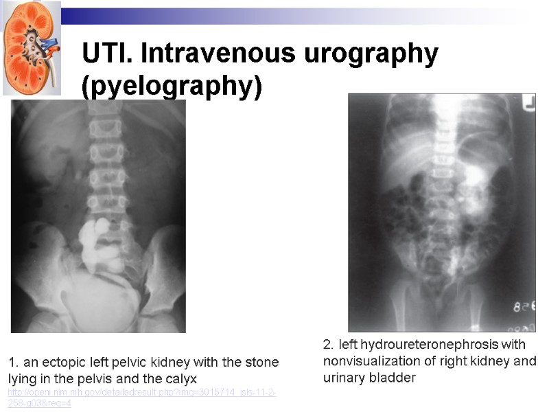 UTI. Intravenous urography (pyelography) 1. an ectopic left pelvic kidney with the stone lying